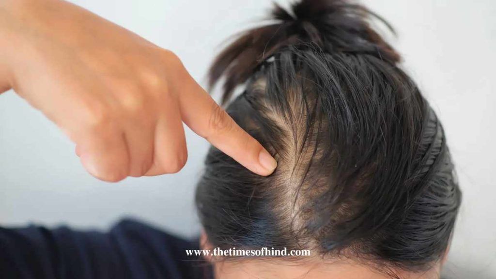 Hair Fall Treatment